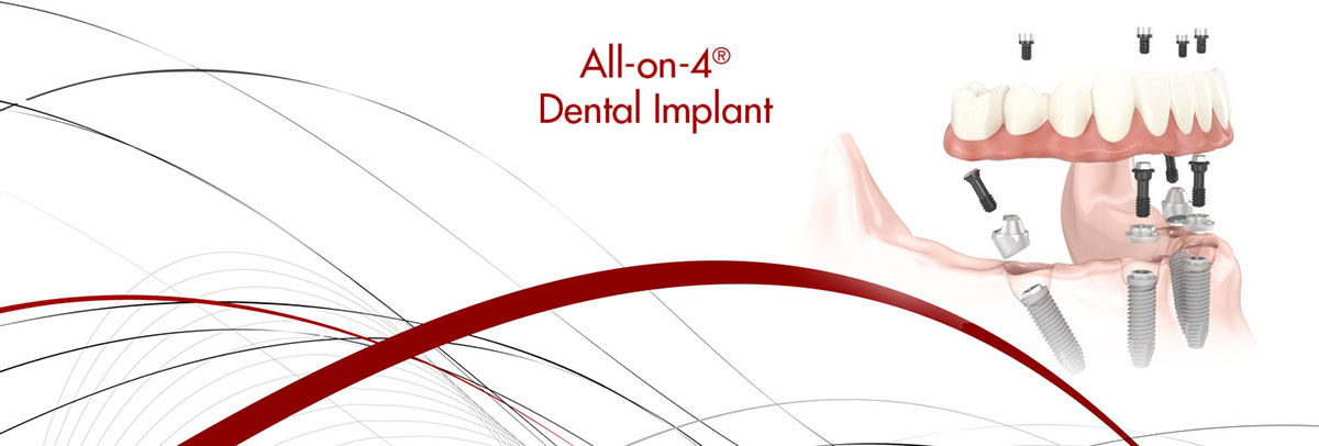 Santa Cruz All-on-4 Dental Implants