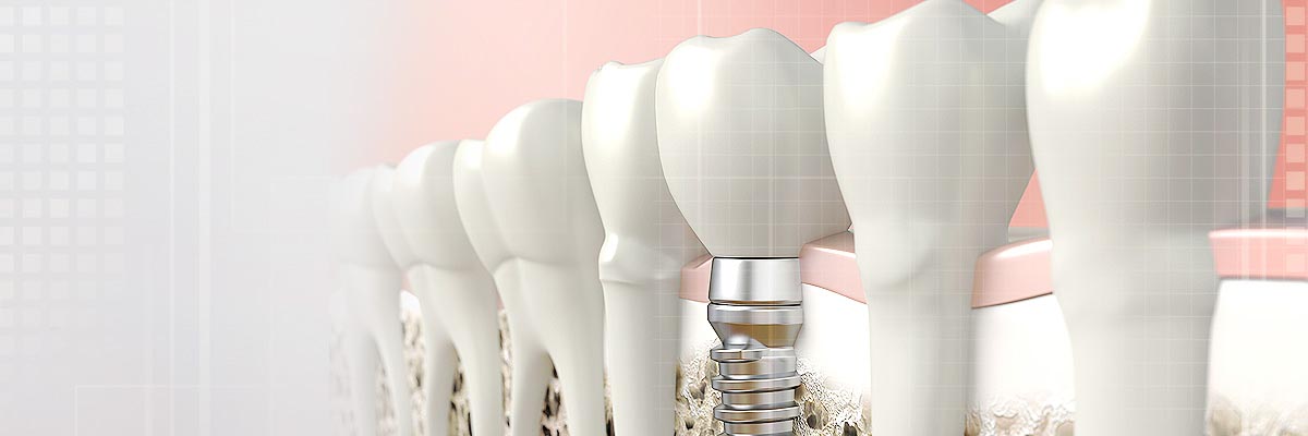 Santa Cruz Tooth Colored Fillings