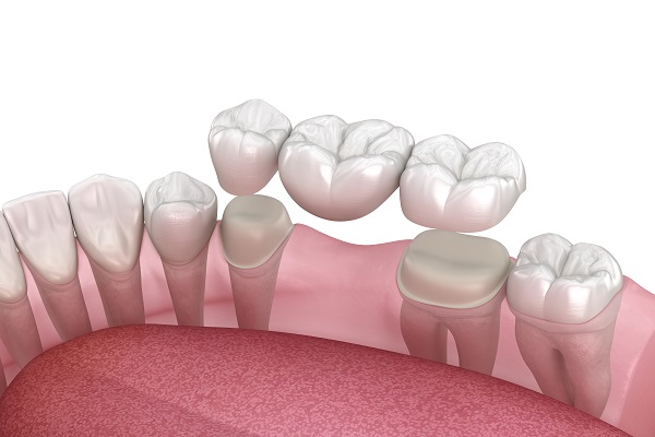 Decided To Get A Dental Bridge To Solve Your Missing Tooth Problem?