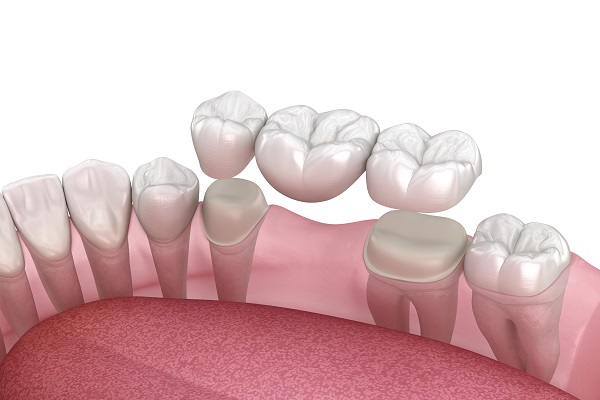 Decided To Get A Dental Bridge To Solve Your Missing Tooth Problem?