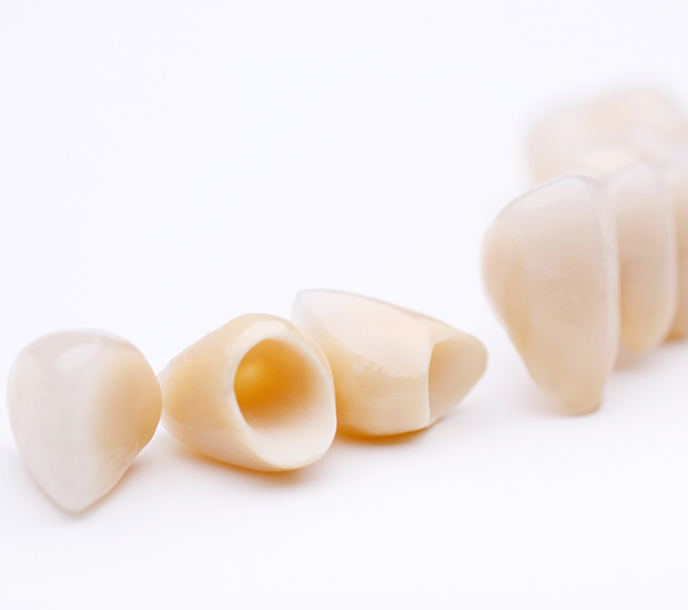 Santa Cruz Dental Crowns and Dental Bridges