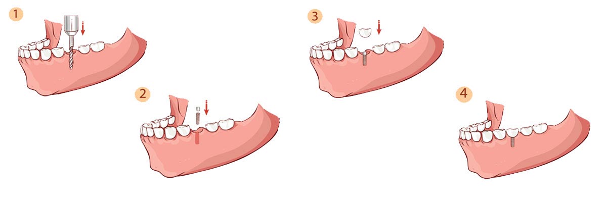 Santa Cruz The Dental Implant Procedure