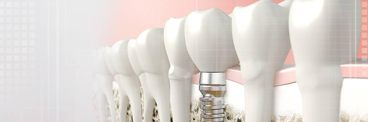Santa Cruz Dental Prosthetics