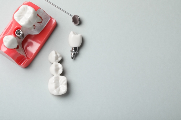 Signs It Is Time To Replace A Dental Implant Restoration