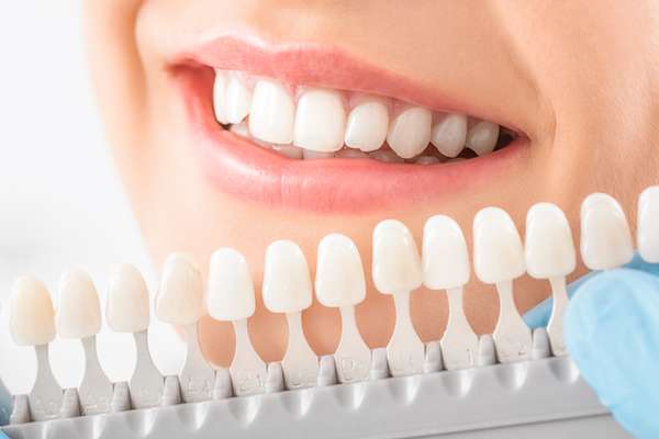 The Importance Of Choosing A Dental Professional For Dental Veneers