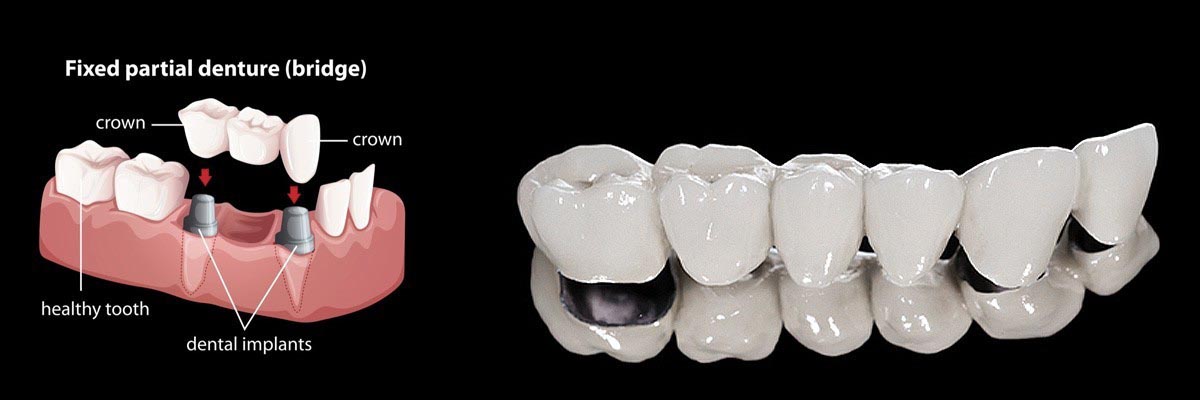 Santa Cruz Dentures