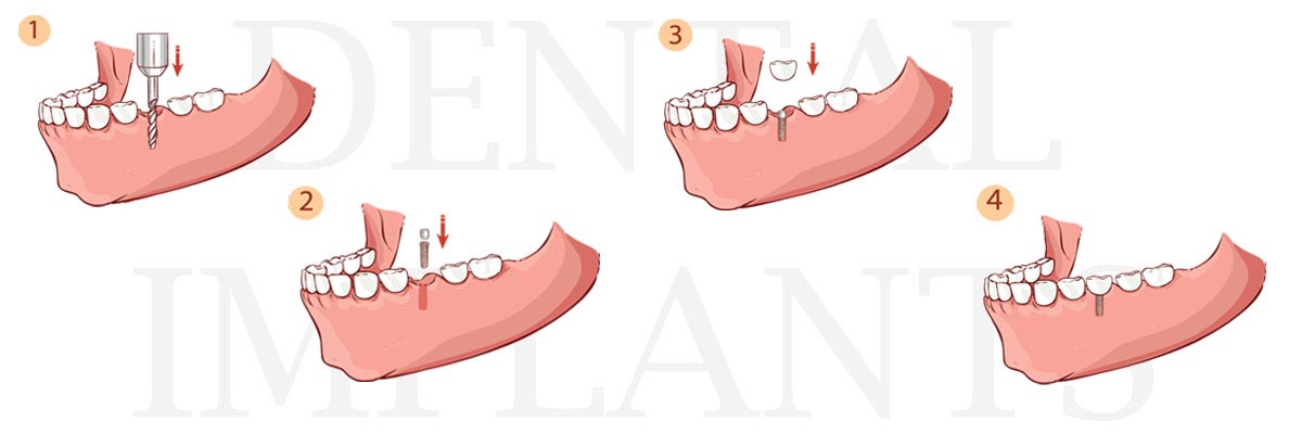 Santa Cruz The Difference Between Dental Implants and Mini Dental Implants