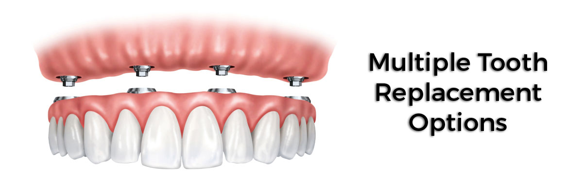 Santa Cruz Multiple Teeth Replacement Options