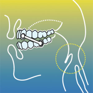 TMJ Treatment