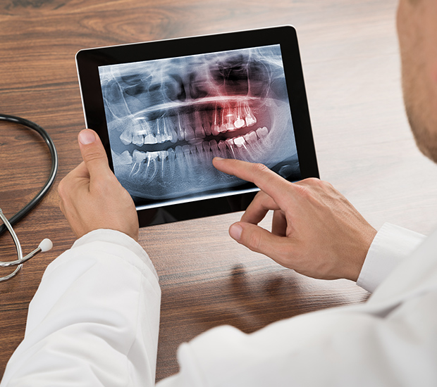 Santa Cruz Types of Dental Root Fractures