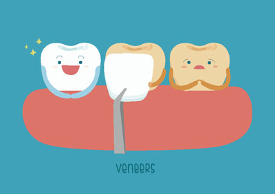 A Guide To Dental Veneers And How We Use Them