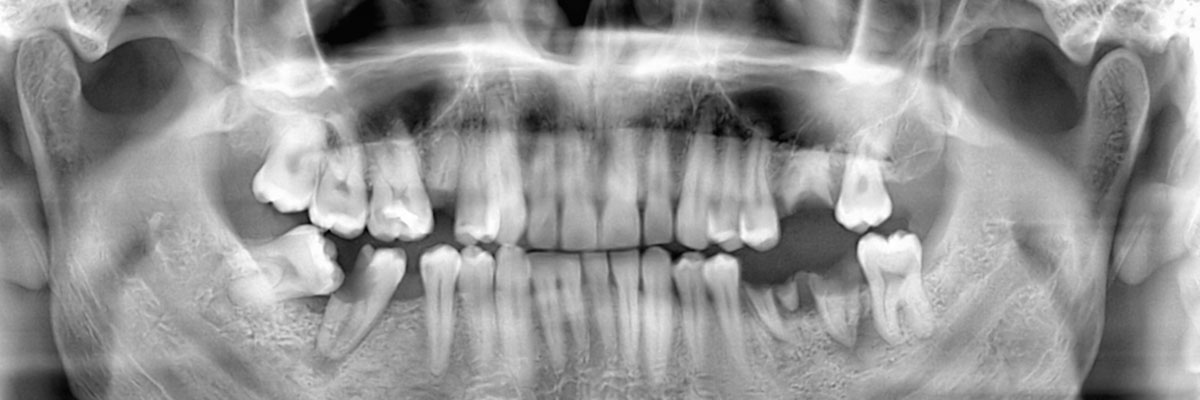 Santa Cruz Wisdom Teeth Extraction